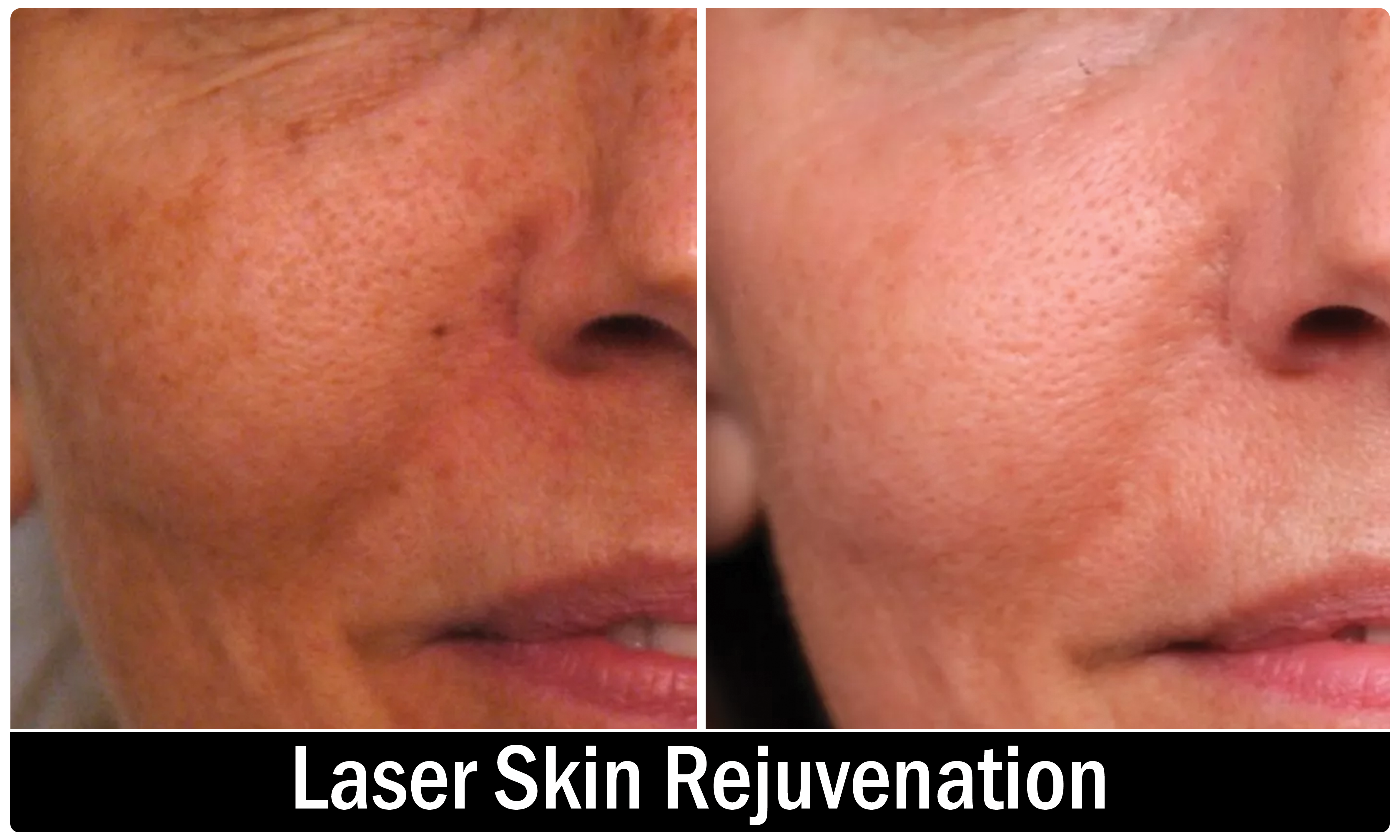 Alar Reduction result KOQ10